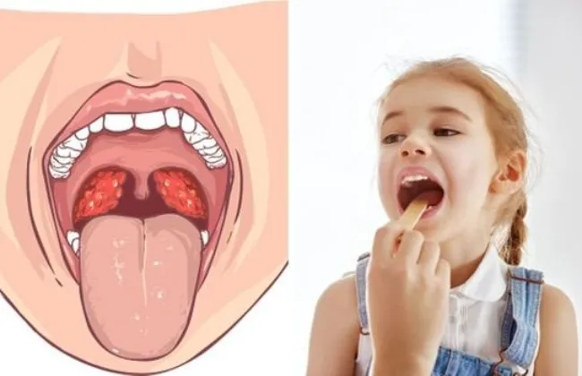 أعراض واضحة لتضخم اللوزتين واللحمية عند الأطفال 