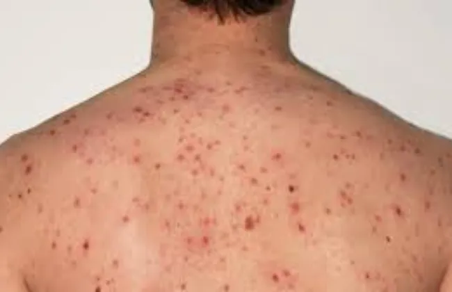 إعلام عبرى: رعب فى إسرائيل بعد انتقال عدوى مرضى الحصبة إلى الأطباء 