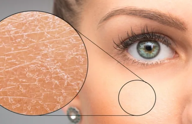 تقشر الجلد رغم الترطيب أسباب خفية وحلول طبية