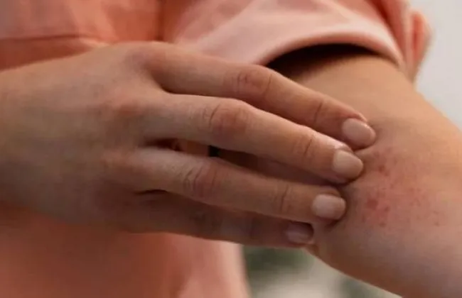 دراسة طبية: اضطرابات النوم تضاعف خطر مشاكل الذاكرة لمرضى التهاب الجلد التأتبي