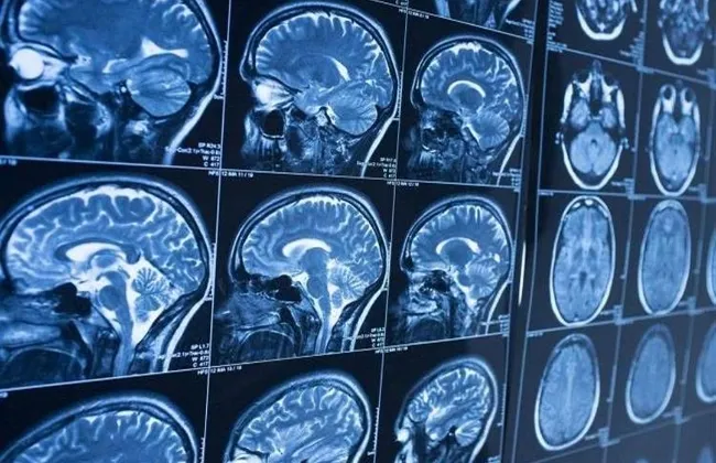 اعتقد الأطباء أنه مصاب بورم.. اكتشاف دودة شريطية فى رأس رجل