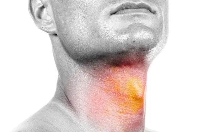 علامات مبكرة لسرطان الفم.. لا تتجاهل البقع البيضاء وصعوبة البلع